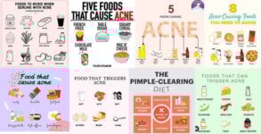 Food, Diet and Acne: The Science