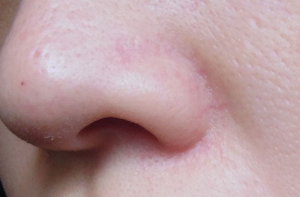 IPL Treatment for Broken Capillaries (Cynosure Icon)