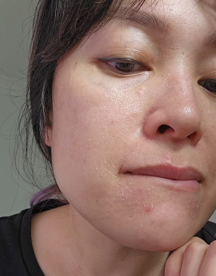 retinoid peeling