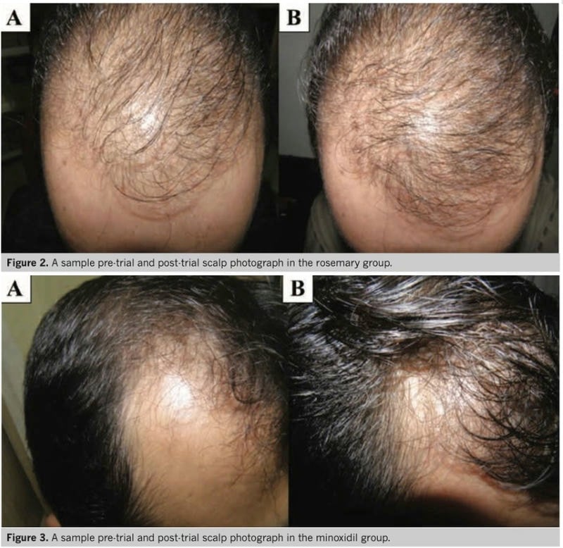 rosemary minoxidil hair regrowth photos